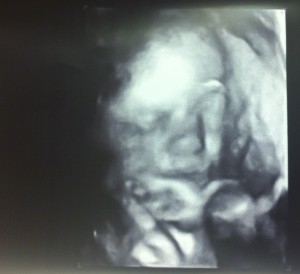 baby girl ultrasound