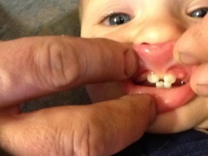 Lip Tie Lip Tie