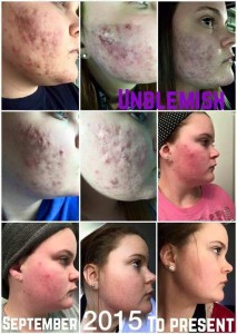 Unblemish Rodan + Fields 